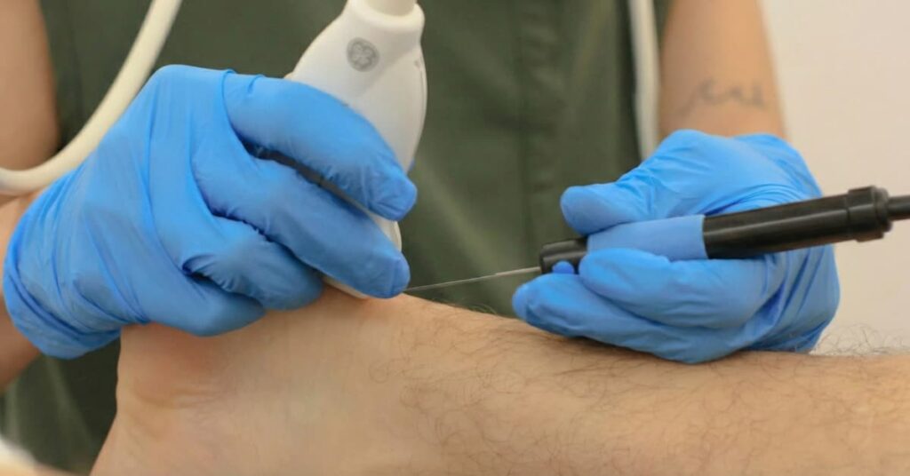 Electrólisis percutánea ecoguiada aplicada en tendón mediante aguja y corriente galvánica para estimular la reparación del tejido.